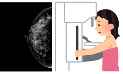 乳がんの検査（マンモグラフィ）